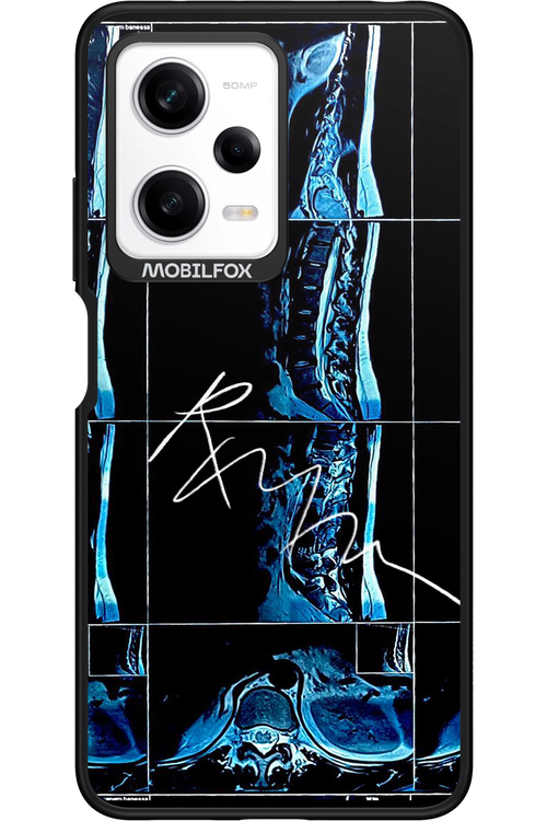 RMN Scolioza 2.0 - Xiaomi Redmi Note 12 Pro 5G