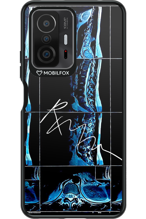 RMN Scolioza 2.0 - Xiaomi Mi 11T