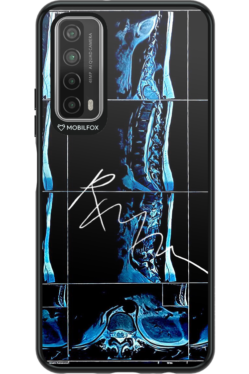 RMN Scolioza 2.0 - Huawei P Smart 2021