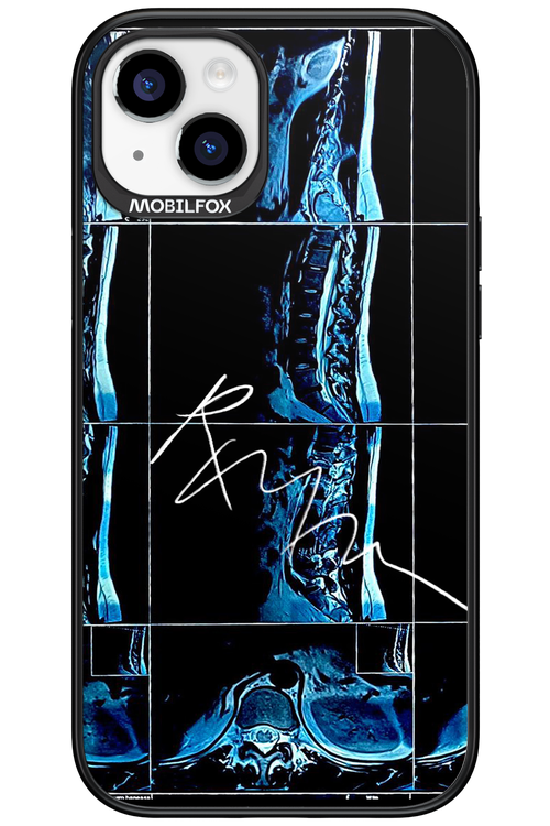 RMN Scolioza 2.0 - Apple iPhone 15 Plus